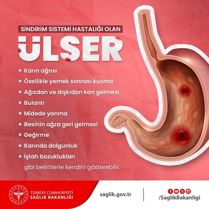 Sağlık Bakanlığı Sindirim Sistemi Hastalığı Olan Ülserin Belirtilerini Paylaştı.