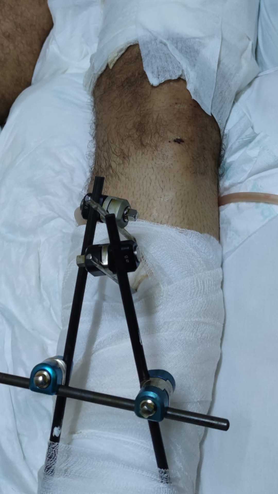 Silahlı Kavgada Bacağı Koptu, Yakınları Adalet Istiyor 7