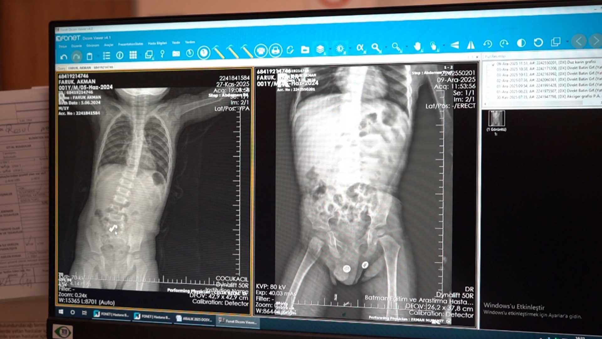 3 Mıknatıs Yutan 1,5 Yaşındaki Çocuk, Ameliyatla Sağlığına Kavuştu 2