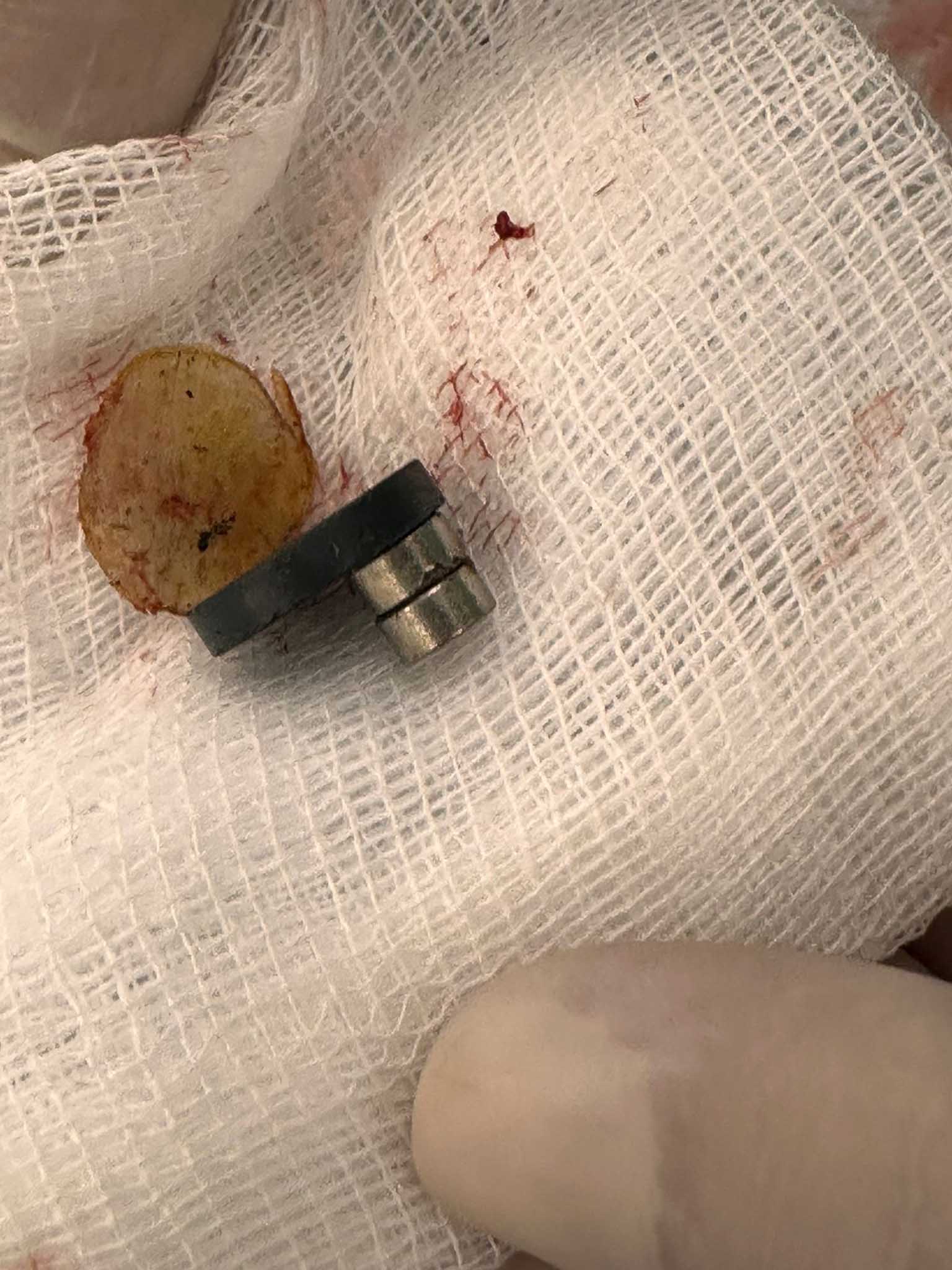 3 Mıknatıs Yutan 1,5 Yaşındaki Çocuk, Ameliyatla Sağlığına Kavuştu 4