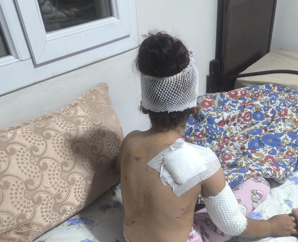 8 Köpeğin Saldırdığı Çocuk Ölümden Döndü 150 Dikiş Atıldı (3)