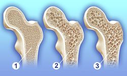 Kemik Erimesinden Korunmak İçin Gençlikten İtibaren Önlem Alın