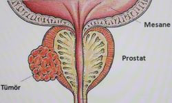 Prostat kanseri nedir ve belirtileri nelerdir?