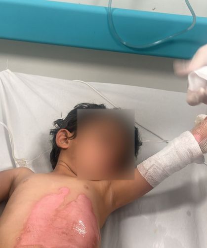 Kaynar Su Dolu Kazan Devrildi, 3 Yaşındaki Çocuk Yaralandı