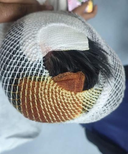 Köpek saldırısına uğrayan 8 yaşındaki öğrencinin başına 15 dikiş atıldı