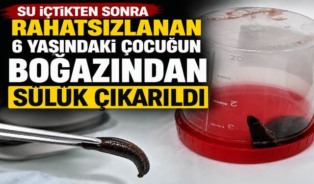 Su İçtikten Sonra Rahatsızlanan 6 Yaşındaki Çocuğun Boğazından Sülük Çıkarıldı